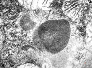 myelinoid inclusion myelinoid inclusion